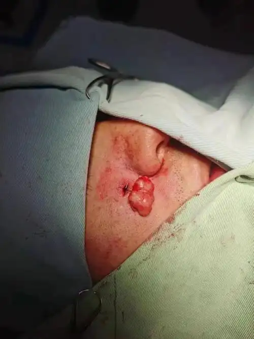 小小皮脂腺囊肿,早发现早治疗