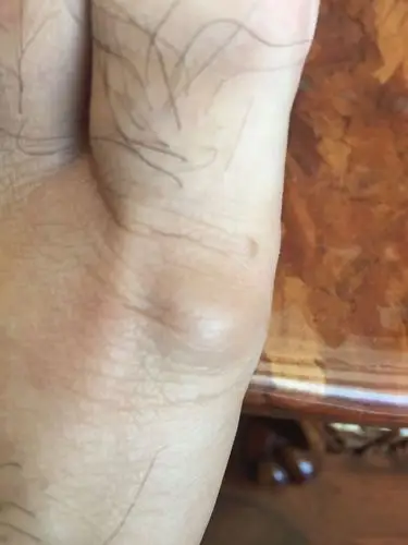 左脚脚趾的血管起了一个大包,按的话里面好像有一根筋一样,稍微有点疼