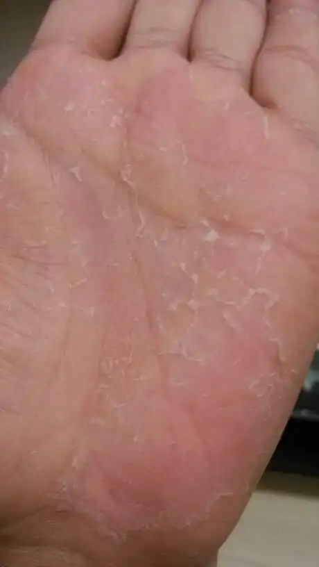 手掌脱皮,不痒不痛,怎么回事,之前试过一次两只手都会脱!