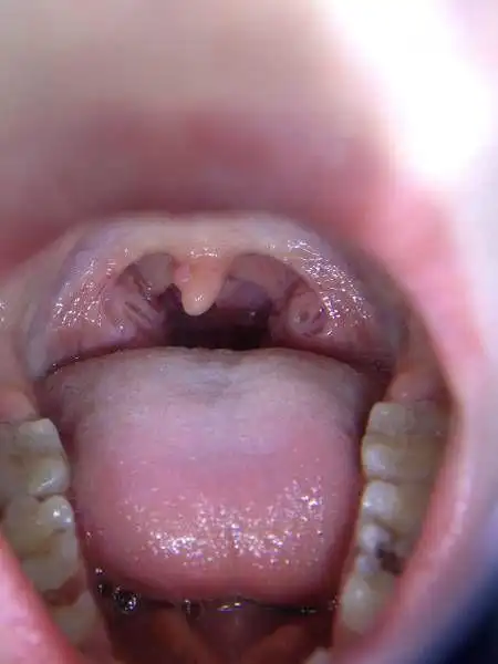 扁桃体恶性肿瘤