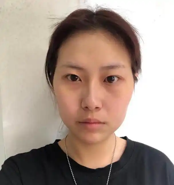 面部凹陷的症状有哪些,如何改善,有什么医美方法?