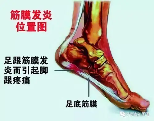 【为了您的健康,我们的专家有话说】足跟痛的黑锅不能全让骨刺来背