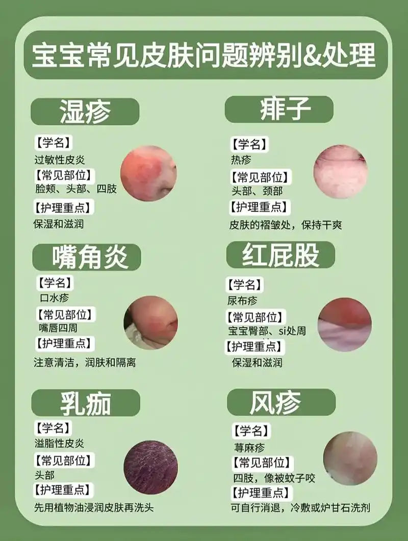 宝宝皮肤问题不要急!|||【湿疹】 宝宝湿 - 抖音