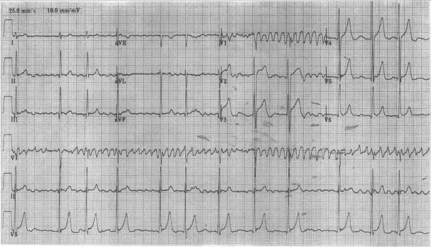 10-39 粗波型心房颤动-心电图诊断解读-医学