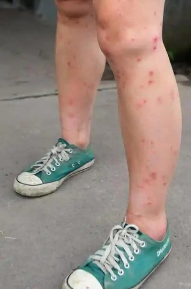 激光祛斑# #悦己挚爱季#  多形红斑是一种急性皮肤炎症,引起的原矣行