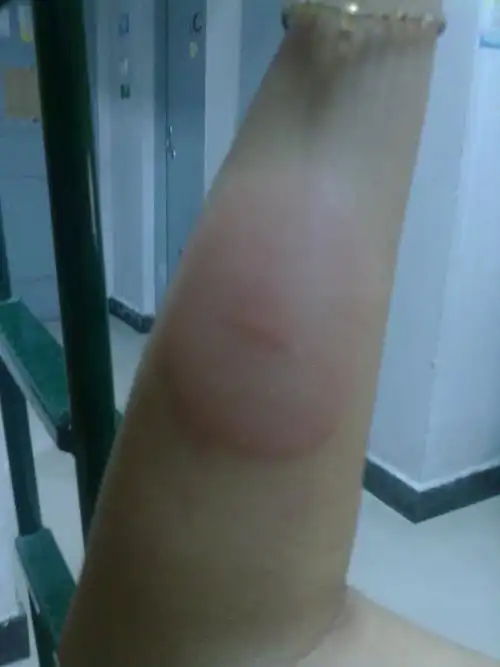 被蜱虫咬了之后的皮肤症状啊.