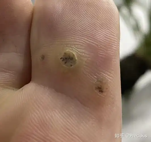 跖疣治疗过程 快完全治愈了(多图 高能 慎点) - 知乎