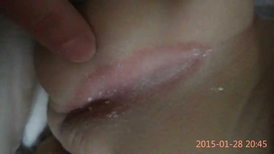 宝宝四个半月了,腿夹子总是红,肛门总是有好多红疙瘩,好长时间了,用药