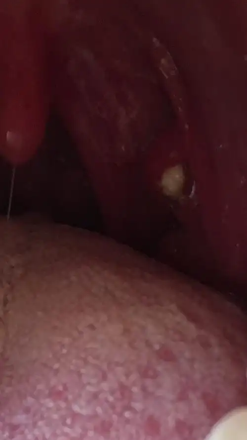 看看嗓子后面这是长了个白东西.严重吗