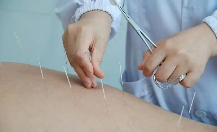 针灸图片 - 菜鸟图库