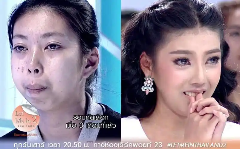 泰国整容秀开播,因丑受尽歧视的男人,整容后震惊了亚洲!