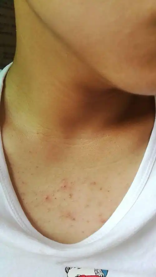 前胸后背糠孢子马拉色毛囊炎-医联