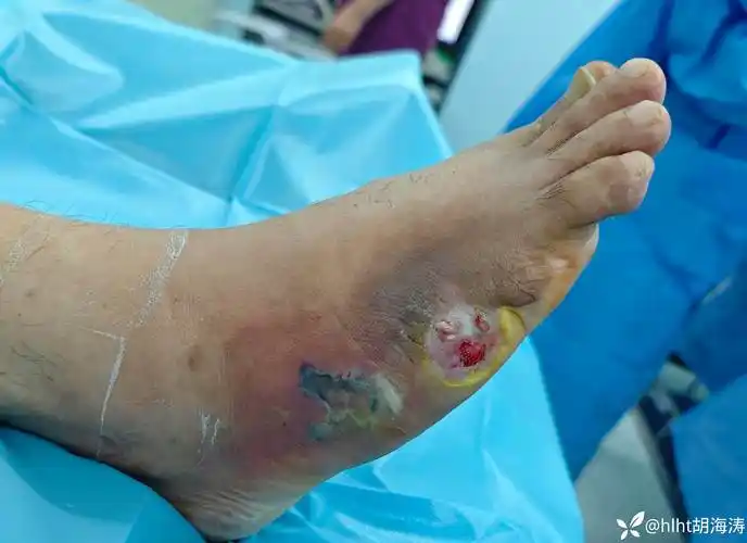 糖尿病足第五足趾溃烂,如出现这种情况感染 ,你知道解剖原因?对策?