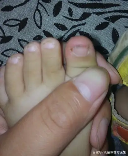 宝宝脚趾甲向上翘起,是怎么回事,该怎么办