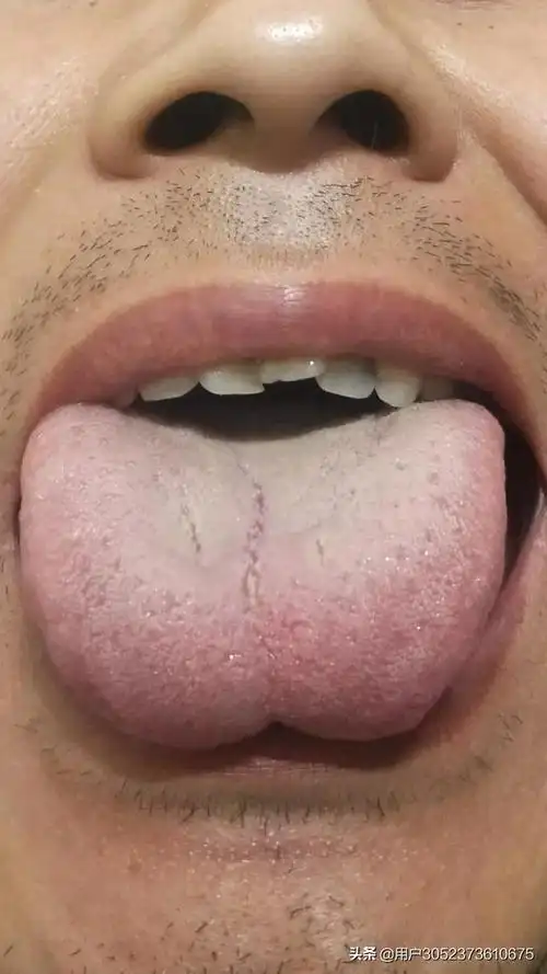 舌象是健康的晴雨表医生可通过舌头的颜色大小等判断身体状况