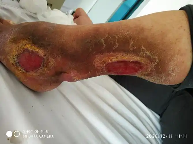 中药治疗下肢破溃一例