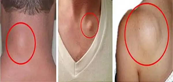 上千人亲测,8天内天然去除难看的脂肪瘤!