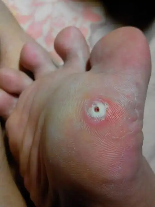 我这是鸡眼还是跖疣?