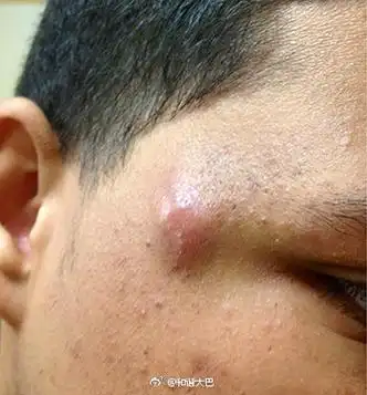 医学上称之为深在性痤疮或者囊肿结节型痤疮,有的本身就是合并炎症的