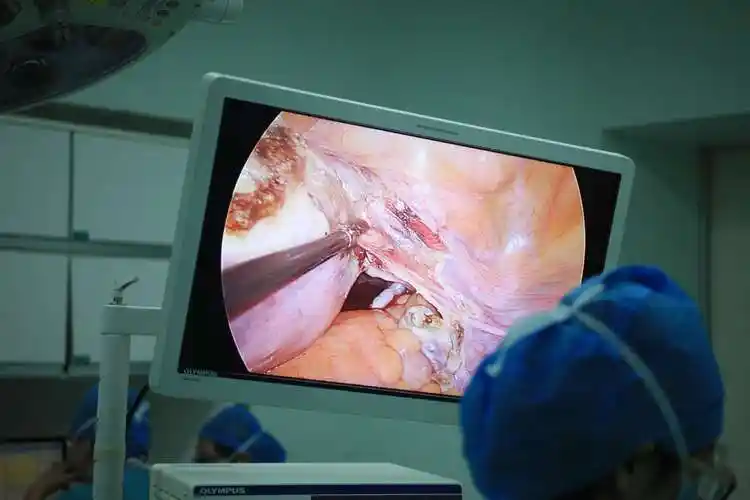 三病区朱前勇教授团队赵洪伟教授单孔腹腔镜子宫切除 卵巢囊肿剥离术