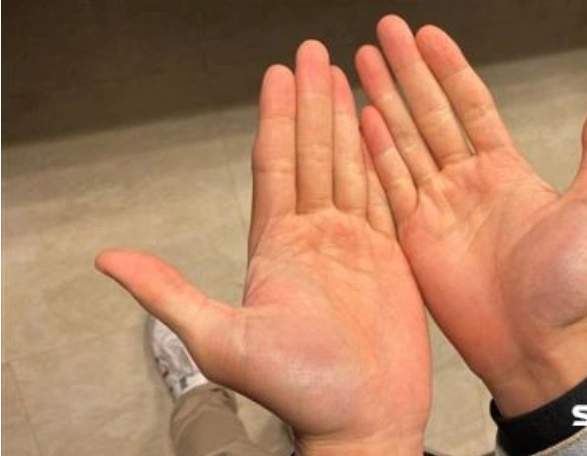 为什么在冬天被打手心比夏天痛,疼痛专家曝真相!