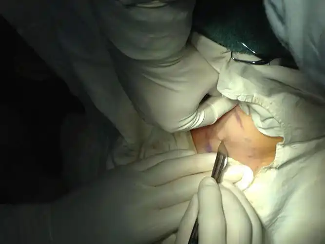 小切口皮瓣修剪法治疗腋臭