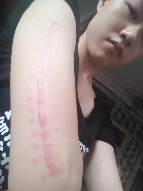 手术疤已经三个半月了,别人的疤痕会越来越细,颜色也会变白但我的还是