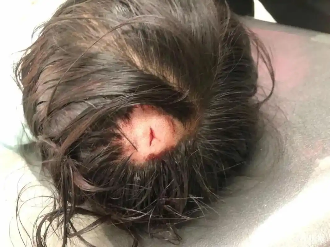 13岁女孩捉迷藏被墙头飞砖砸破脑袋!孩子说:是一个健身阿姨