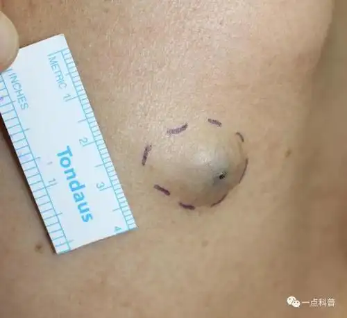 四,其他比如脂肪瘤生长在皮下,较其他浅表皮肤肿物相比位置较深,多数