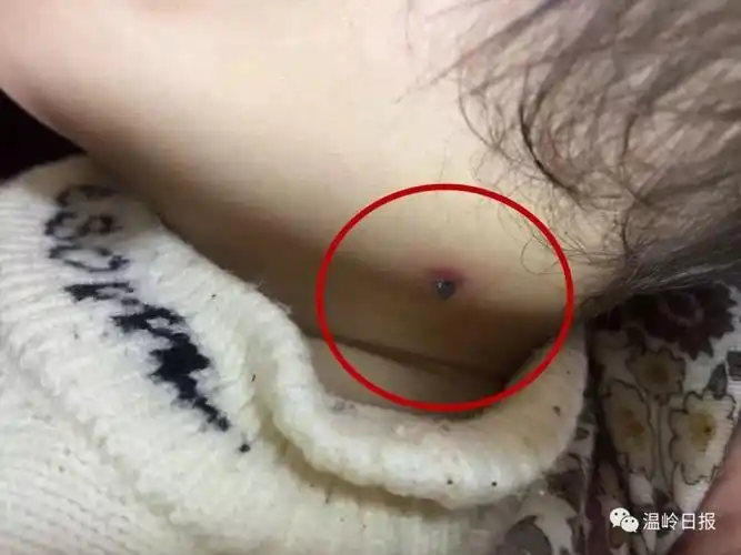 颈部被蜱虫咬了, 整个虫体露在外面, 而头及口器钻进皮肤里面. 急!