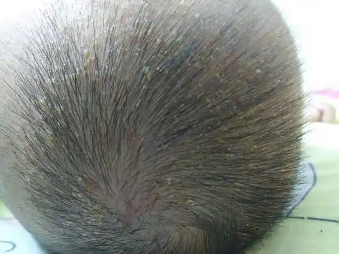我家宝宝脸上是湿疹么 头顶也是湿疹么 还是头皮脂溢性皮炎