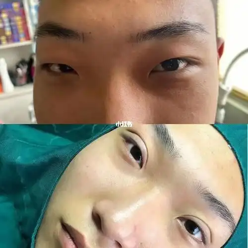 男孩也有爱美的权利单眼皮变双眼皮迷人帅哥