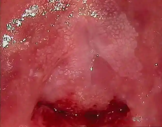 多图干货阴道镜下6种异常宫颈图像详解值得收藏