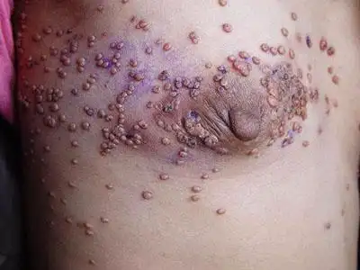 针头大的毛囊性丘疹,密集成片,每个丘疹顶端有一根丝状角质小棘