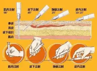 打疫苗严格说来指的是疫苗的给药方式——即注射疫苗,主要包括肌内