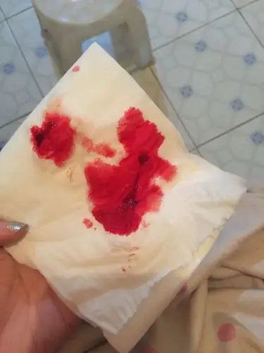 这段时间大便后擦屁股都有小块血液,今天小腹微坠痛