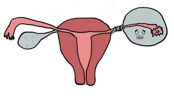 卵巢囊肿蒂扭转一直痛需要动手术吗