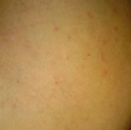 皮肤上小红点,是什么病啊?