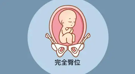 胎儿臀位是什么姿势图:单臀位/完全臀位/不完全臀位