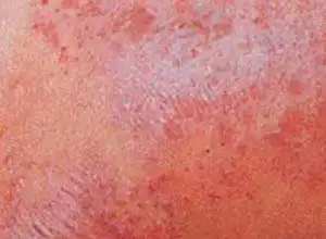 湿疹肛周湿疹是一种常见的非传染性皮肤病,病变多局限于肛门周围皮肤