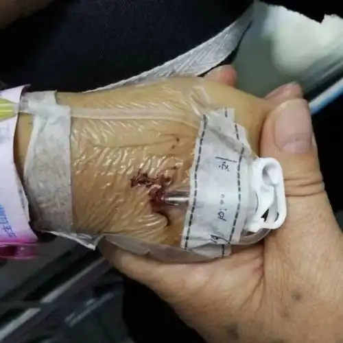 质控发现静脉留置输液竟有这么多问题转发提醒所有护士