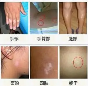 (5)白斑颜色:色素脱失的程度因人而异,因脱色程度不同而显示白,灰白