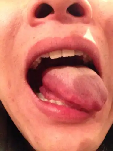 请帮我看看舌头侧面正常,红色和白色界线叫什么