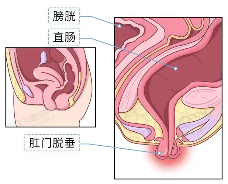 从肛门垂脱向外翻出的一种疾病肛管,直肠(严重时乙状结肠也会)简单来