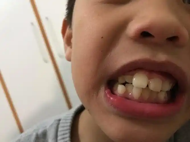 请问,我家八岁的孩子换牙期有点龅牙