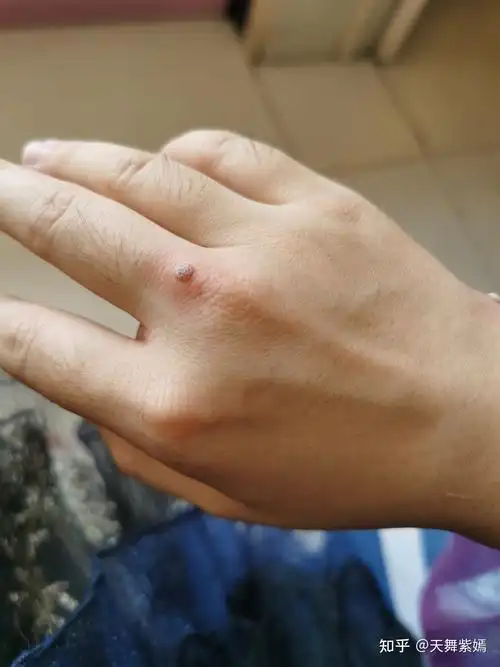 记录我的瘊子冷冻到脱落过程 - 知乎