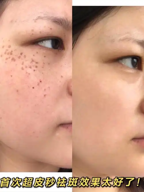 关于超皮秒祛斑首次超皮秒祛斑的干货