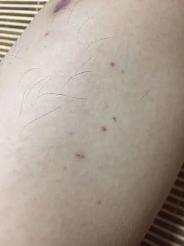 小腿出现红色点点,不疼不痒,请有经验的大夫帮我看看是啥