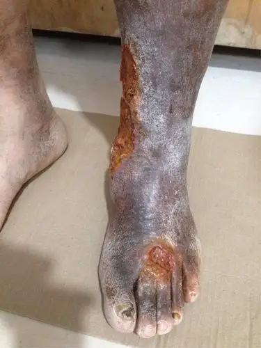 威县二十多年静脉曲张老烂腿四处投医未果,慕名就诊治疗效果对比