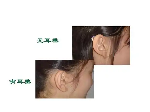无耳垂 有耳垂